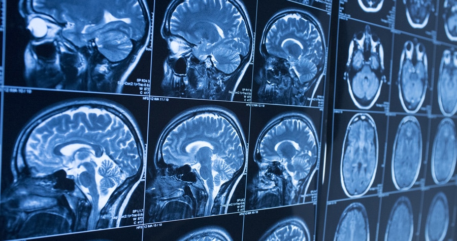 Be on the Lookout for Brain Injury Symptoms after a Miami Car Accident