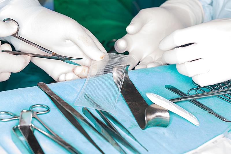 Should I File a Hernia Mesh Lawsuit in Florida?