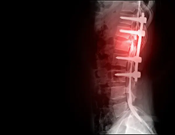 Spinal Cord Injury Attorneys