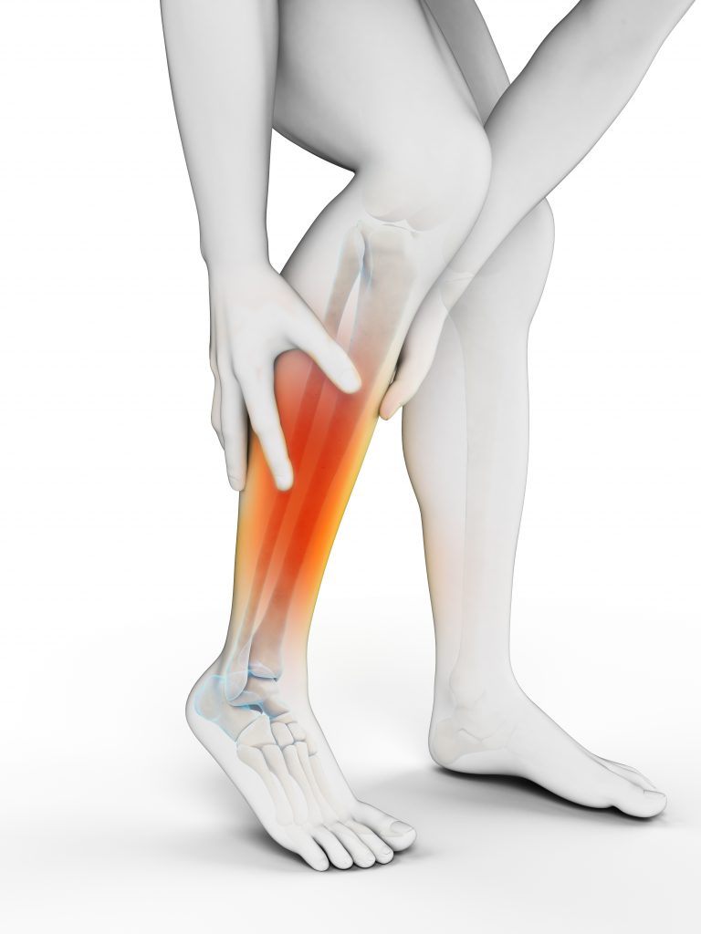 Why You Should Seek Medical Malpractice Legal Help If You Have Complications from Delayed Diagnosis or Treatment of Compartment Syndrome